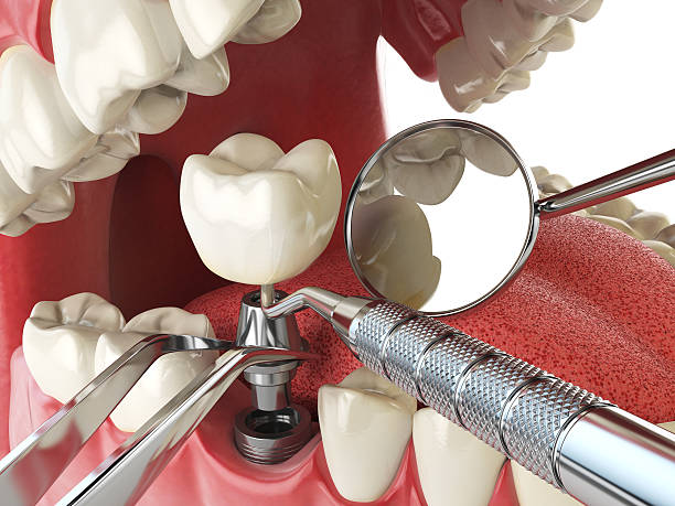 Best Lost Filling or Crown Replacement in Sheboygan Falls, WI